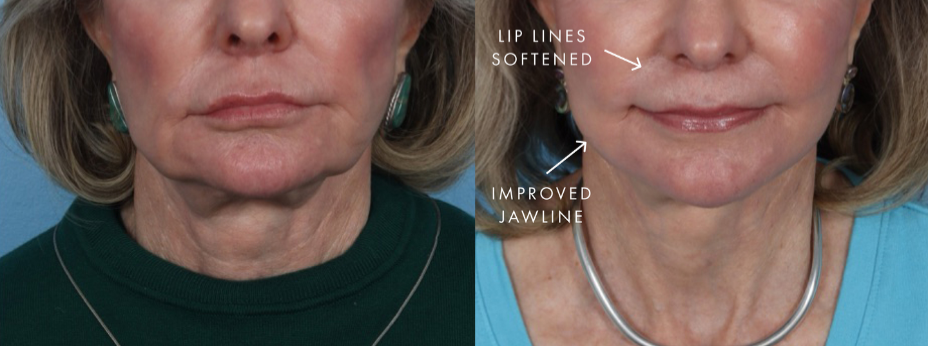 before and after laser resurfacing