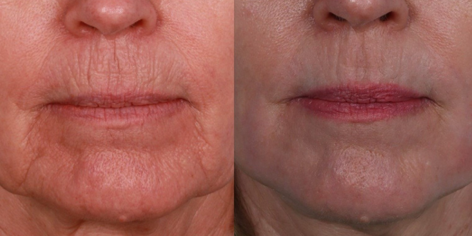 before and after co2 laser - 01