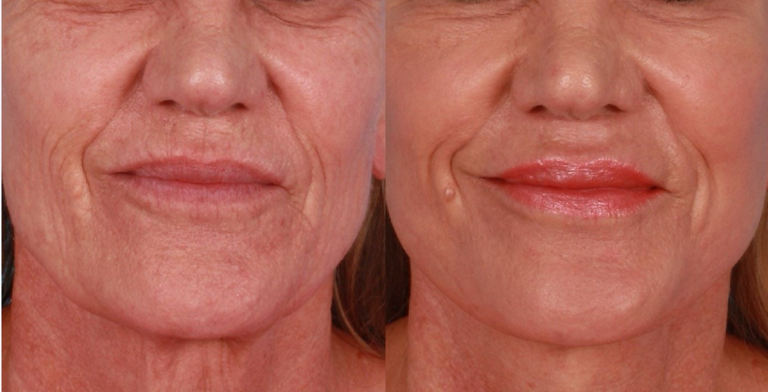 before and after co2 laser - 02