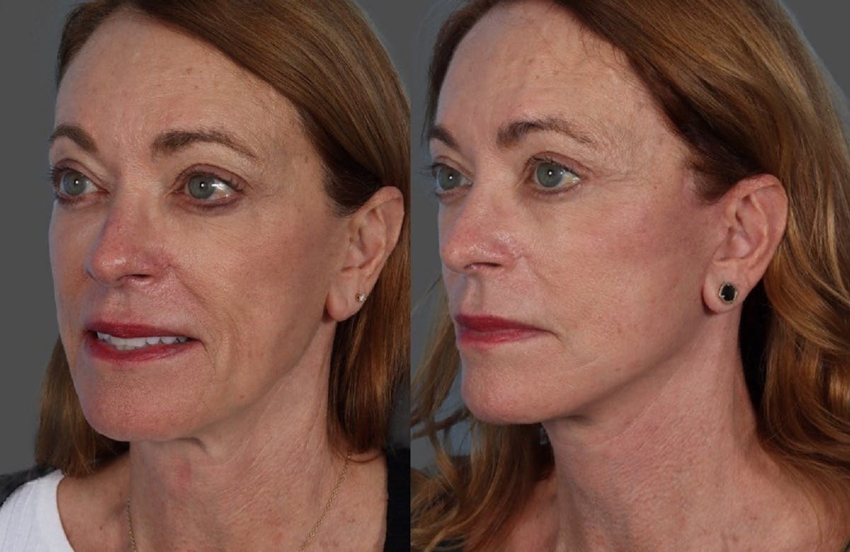 Limited Incision Facelift Before & After Gallery - Patient 398845 - Image 5