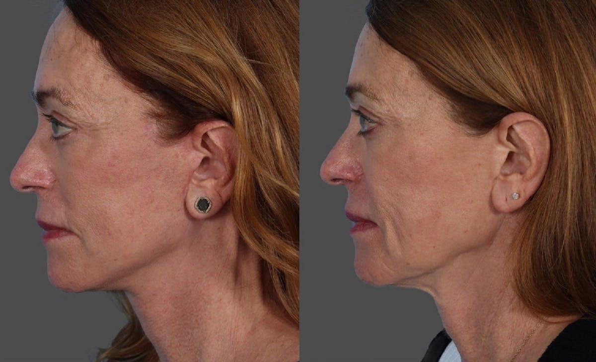 Limited Incision Facelift Before & After Gallery - Patient 398845 - Image 4