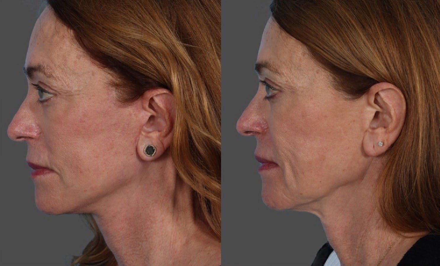 Eyelid Surgery (Blepharoplasty) Before & After Gallery - Patient 779954 - Image 4