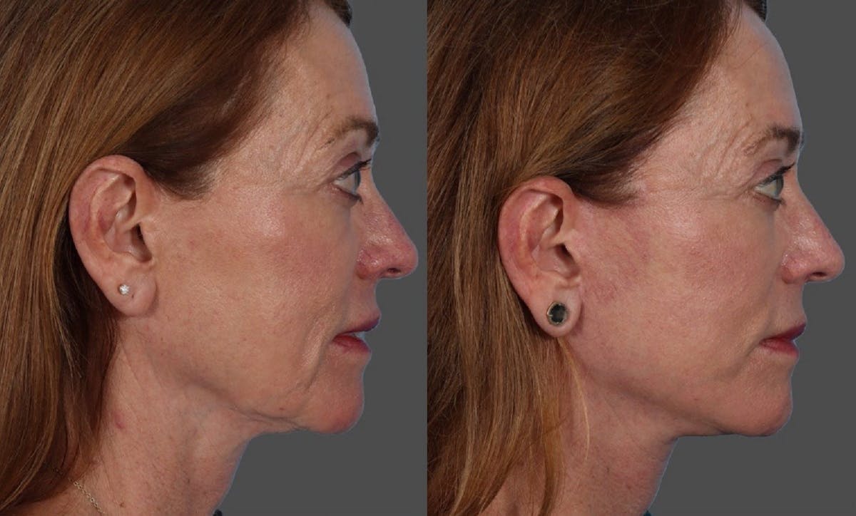 Limited Incision Facelift Before & After Gallery - Patient 398845 - Image 6