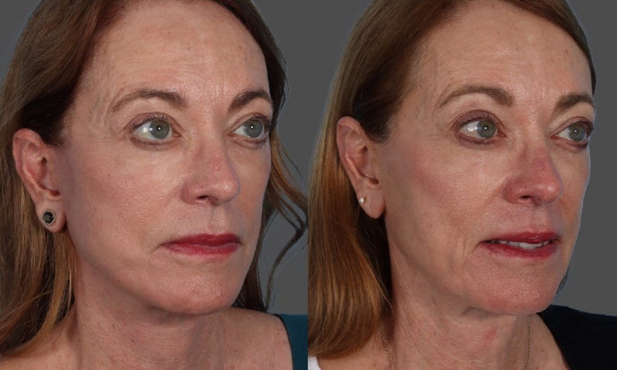 Limited Incision Facelift Before & After Gallery - Patient 398845 - Image 3