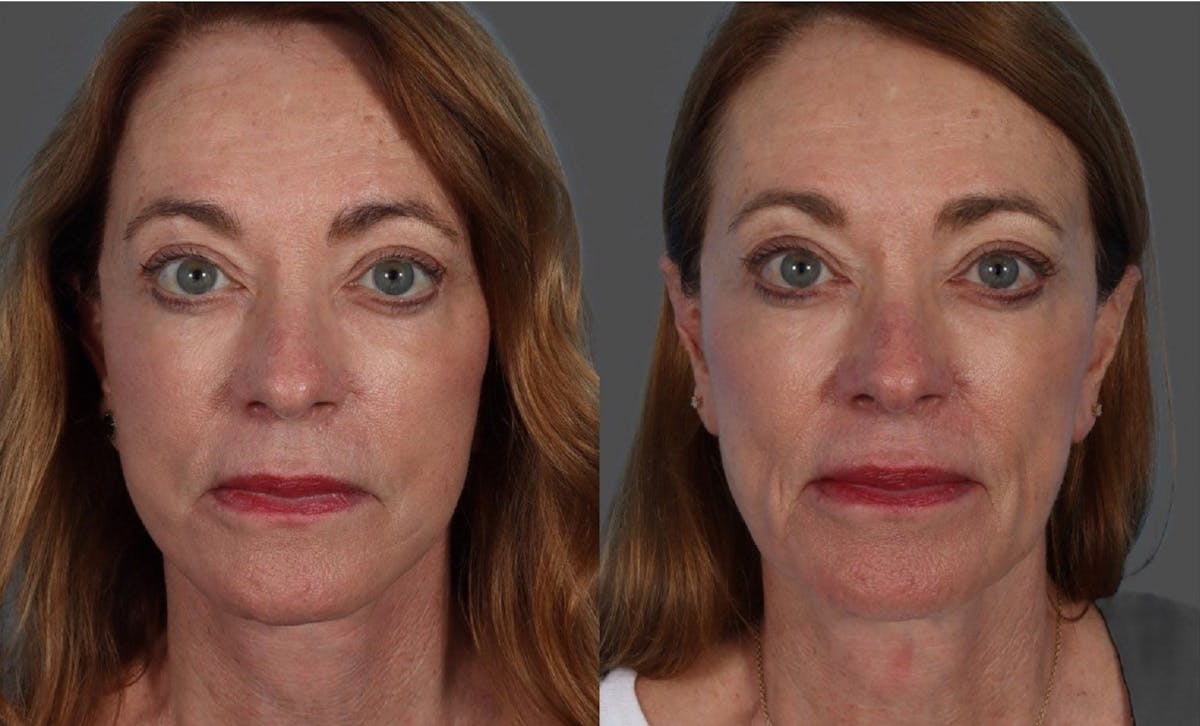 Limited Incision Facelift Before & After Gallery - Patient 398845 - Image 1