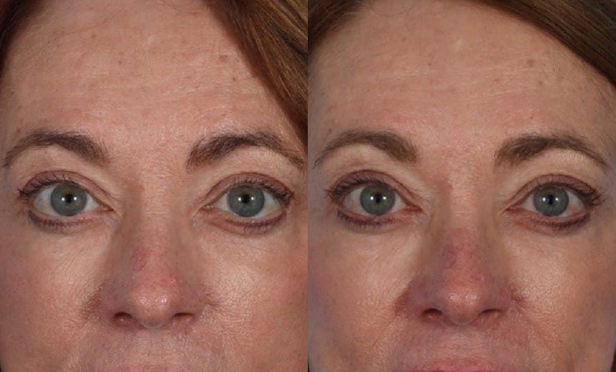 Limited Incision Facelift Before & After Gallery - Patient 398845 - Image 2