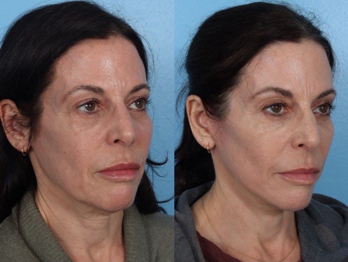 Limited Incision Facelift Before & After Gallery - Patient 213045 - Image 2