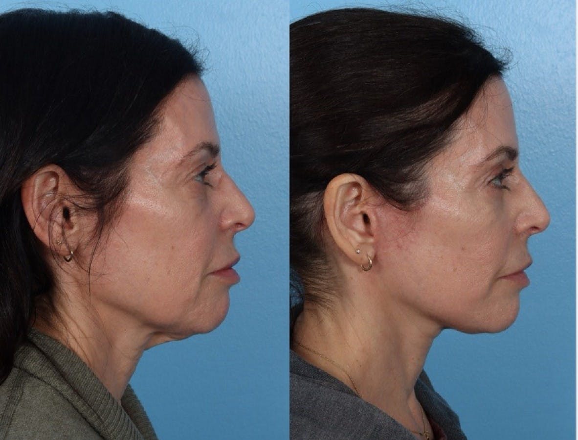 Limited Incision Facelift Before & After Gallery - Patient 213045 - Image 3