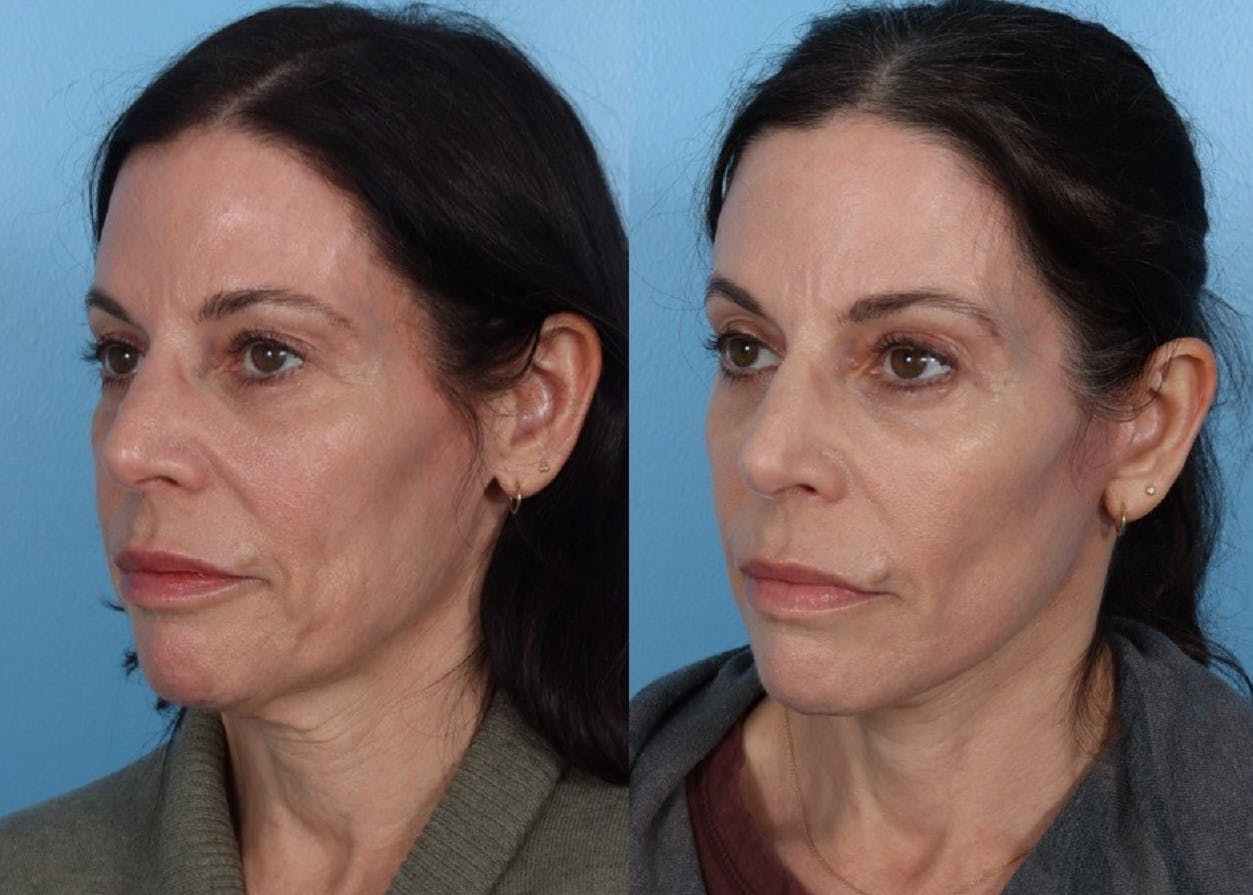 Limited Incision Facelift Before & After Gallery - Patient 213045 - Image 4