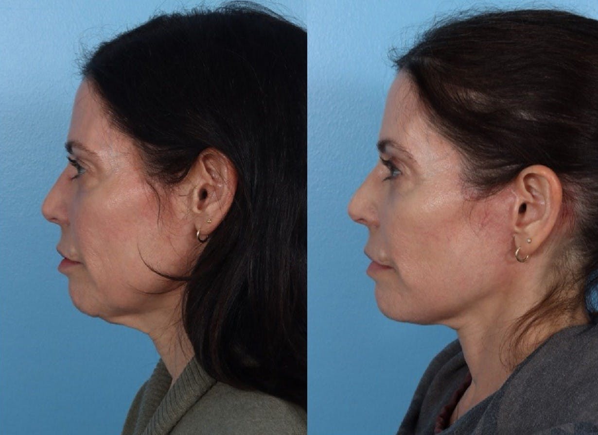 Limited Incision Facelift Before & After Gallery - Patient 213045 - Image 5