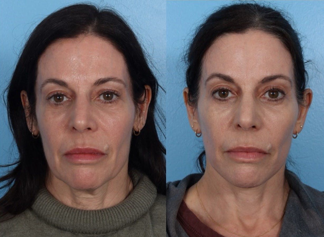 Limited Incision Facelift Before & After Gallery - Patient 213045 - Image 1