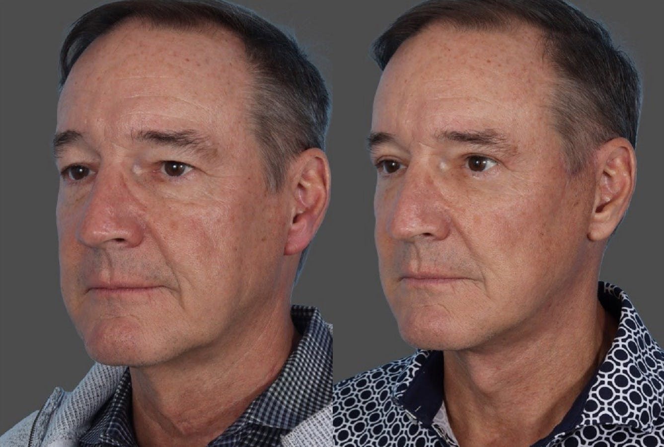 Facelift Before & After Gallery - Patient 231760 - Image 4