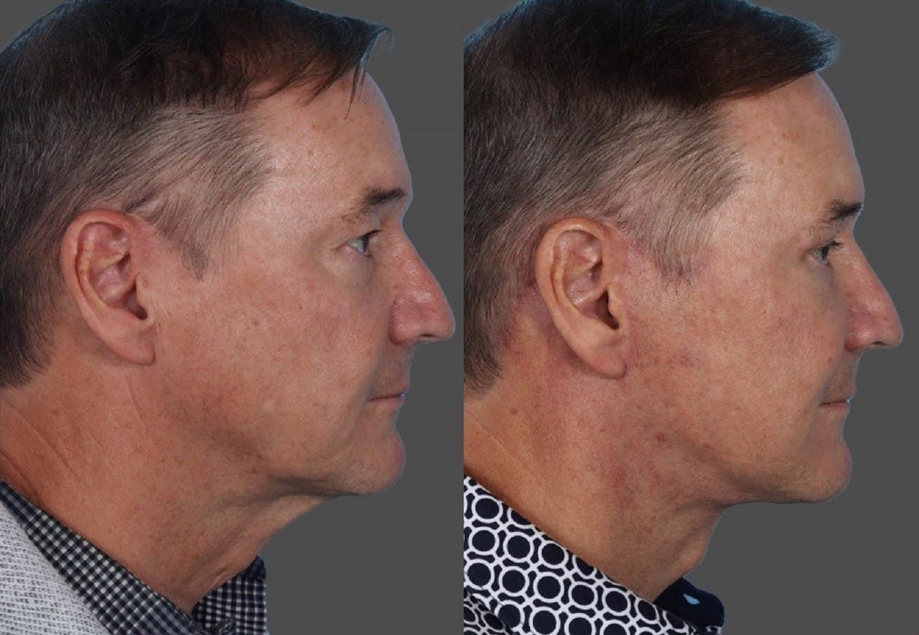 Facelift Before & After Gallery - Patient 231760 - Image 3