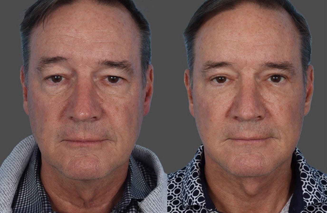 Facelift Before & After Gallery - Patient 231760 - Image 1