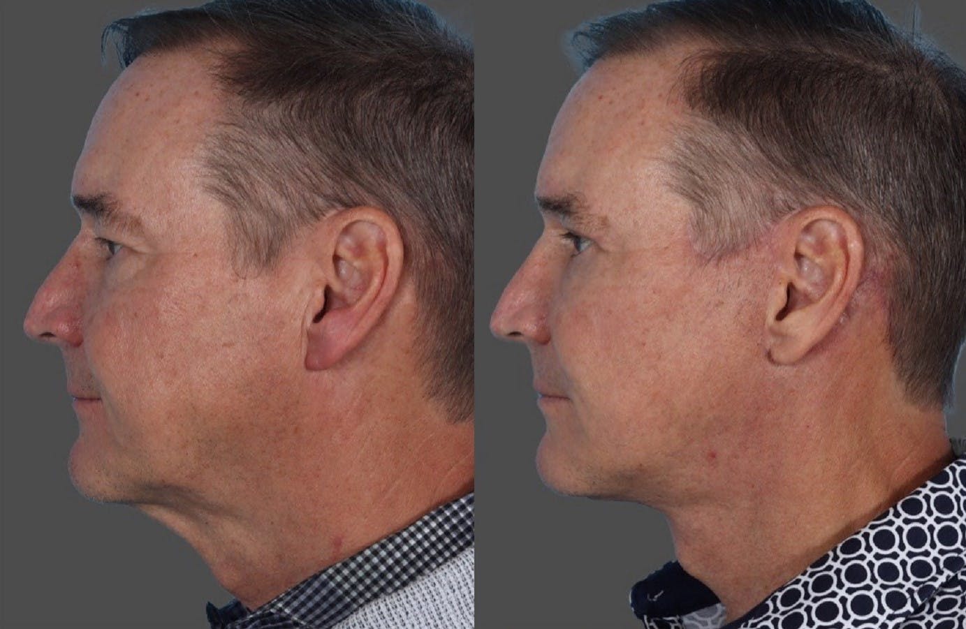Facelift Before & After Gallery - Patient 231760 - Image 5