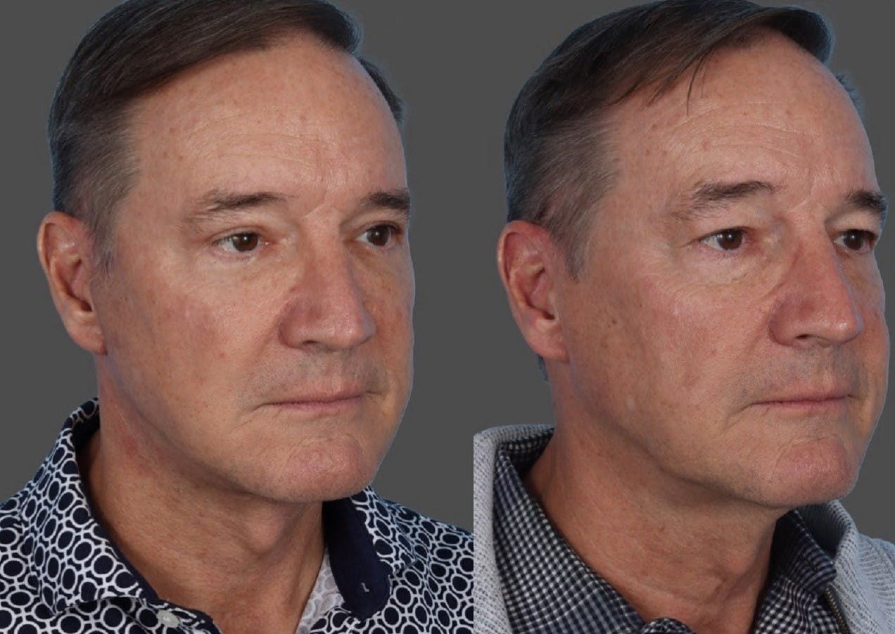 Facelift Before & After Gallery - Patient 231760 - Image 2