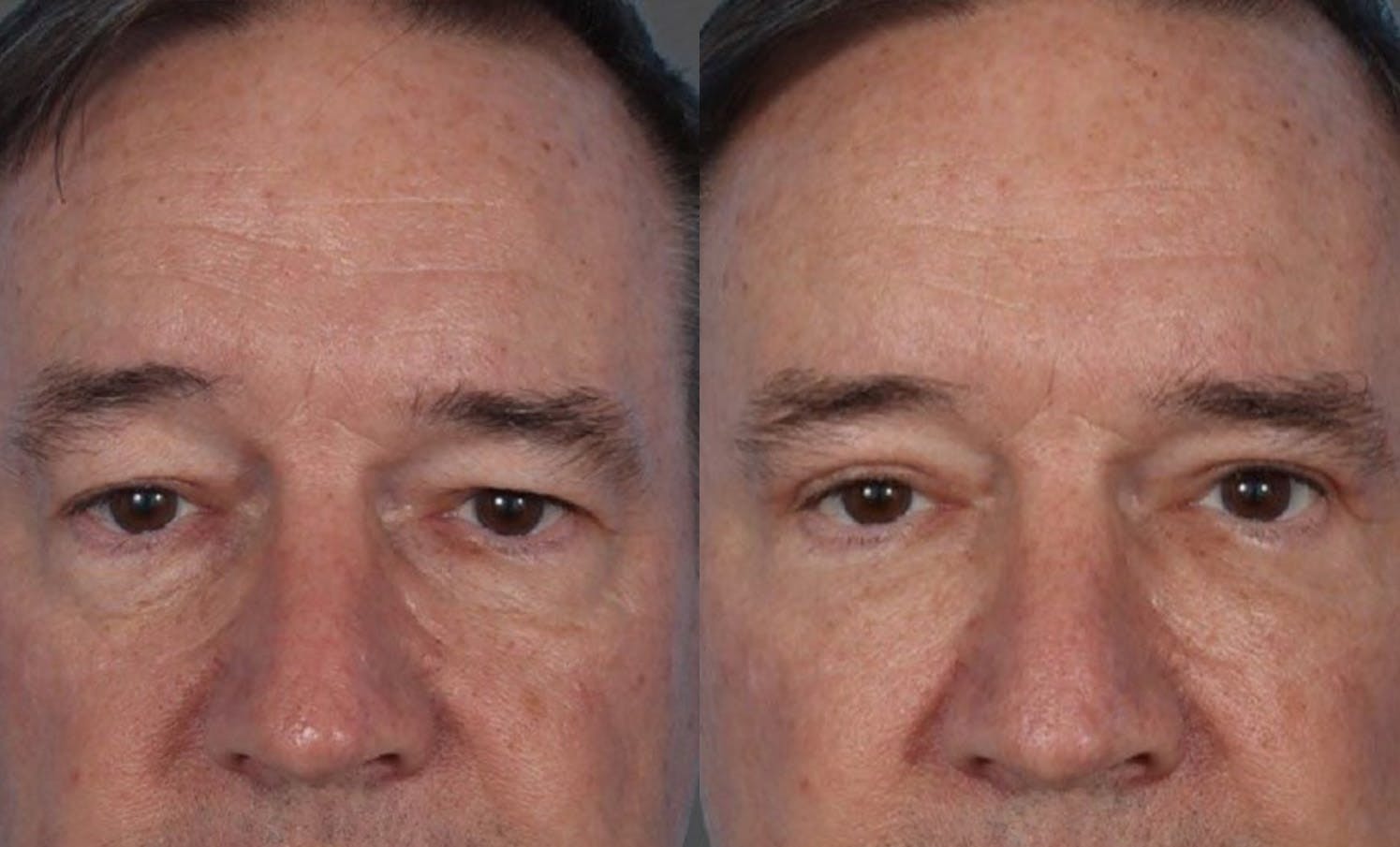 Facelift Before & After Gallery - Patient 231760 - Image 6