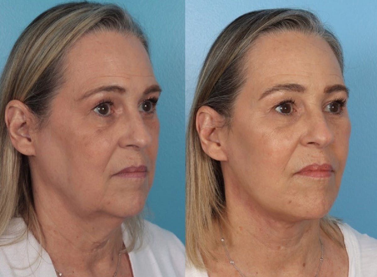Facelift Before & After Gallery - Patient 344540 - Image 2