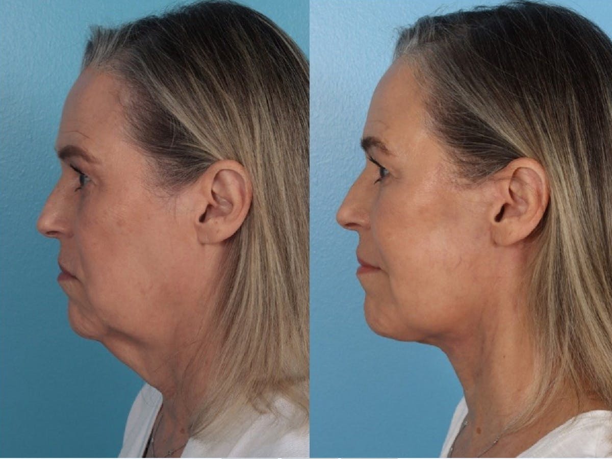 Facelift Before & After Gallery - Patient 344540 - Image 3