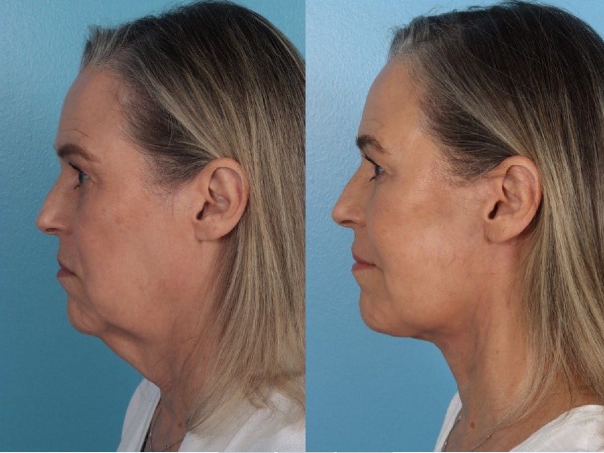 Submental Microliposuction  Before & After Gallery - Patient 141470 - Image 3