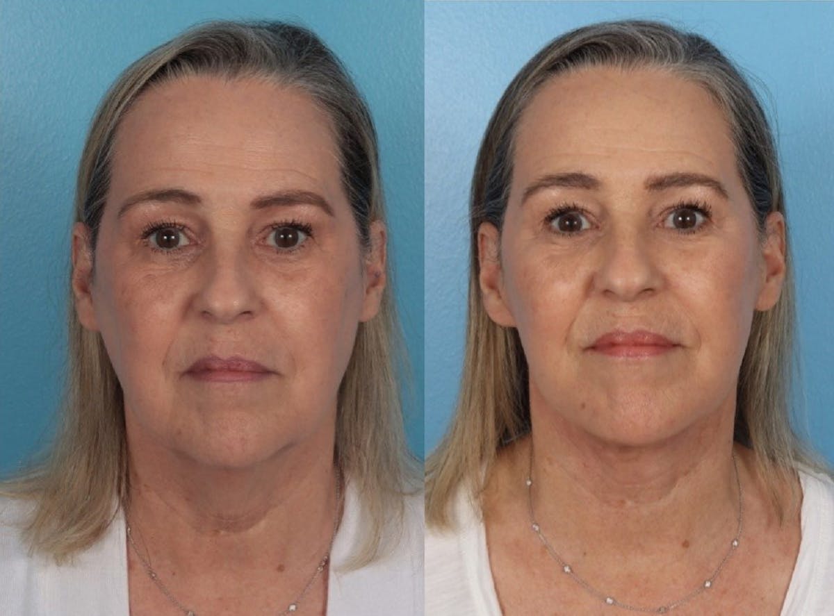 Facelift Before & After Gallery - Patient 344540 - Image 1