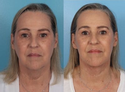 Facelift Before & After Gallery - Patient 344540 - Image 1