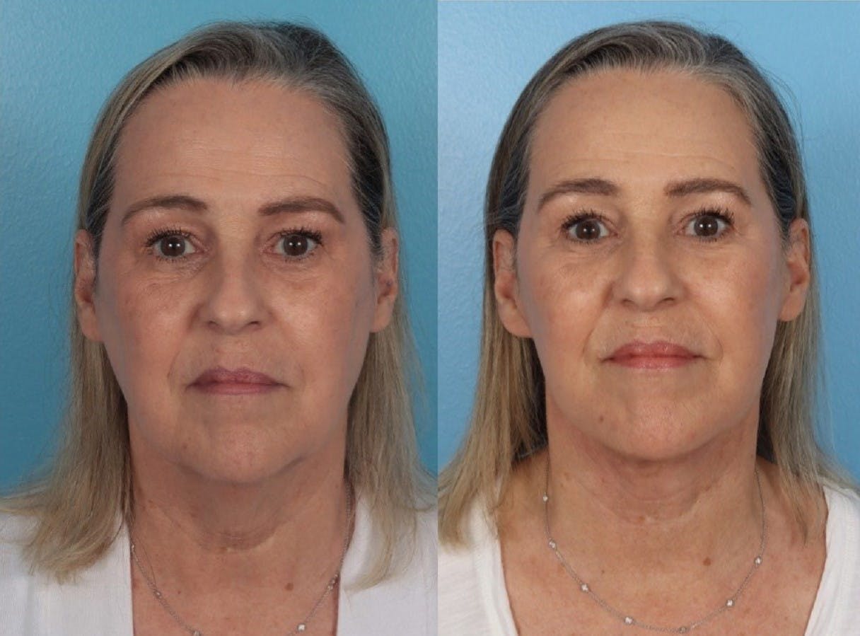 Submental Microliposuction  Before & After Gallery - Patient 141470 - Image 1