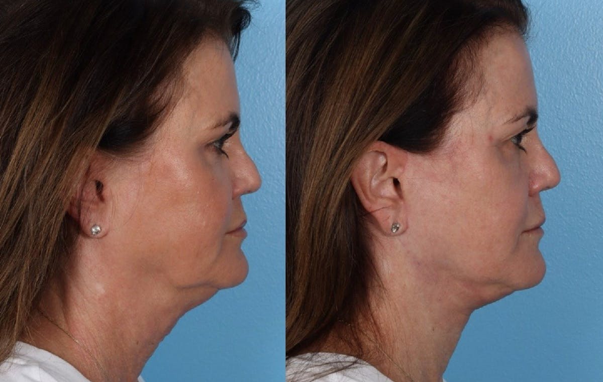 Submental Microliposuction  Before & After Gallery - Patient 235360 - Image 3