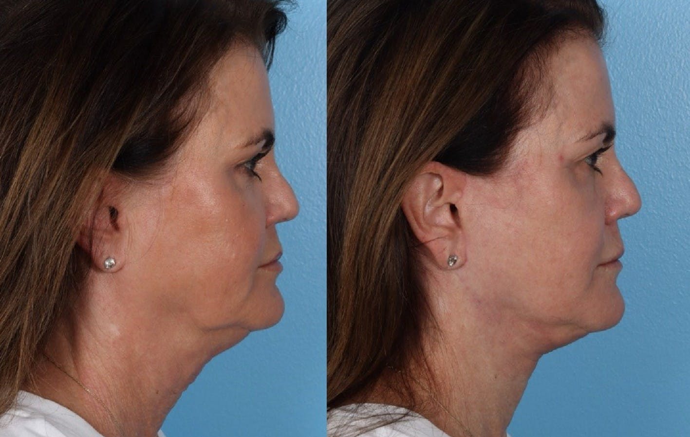 Facelift Before & After Gallery - Patient 796954 - Image 3