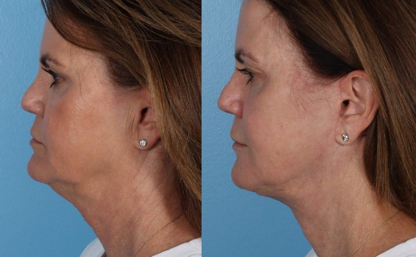 Facelift Before & After Gallery - Patient 796954 - Image 5