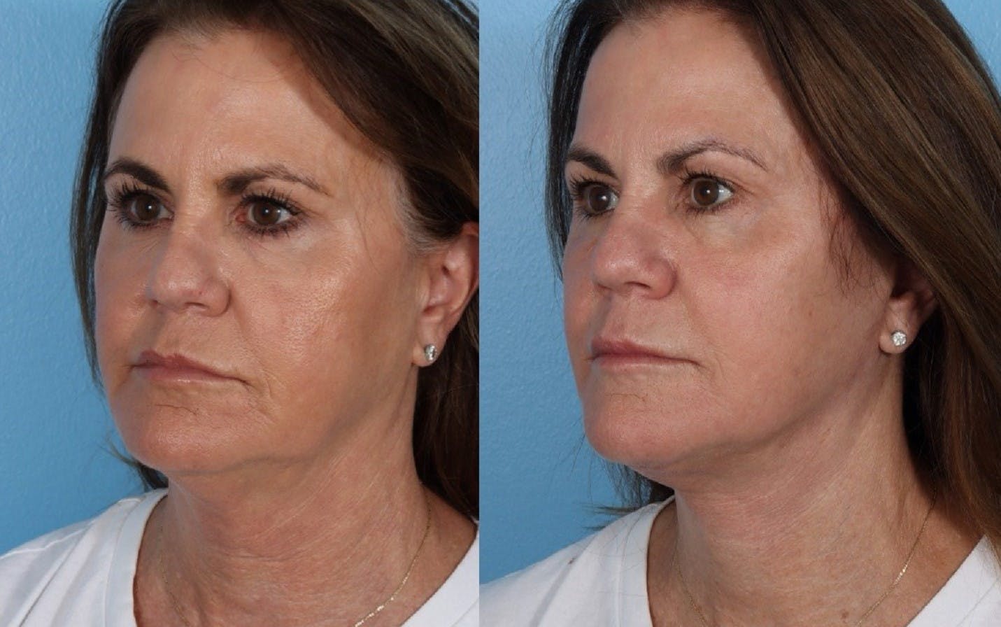 Facelift Before & After Gallery - Patient 796954 - Image 4