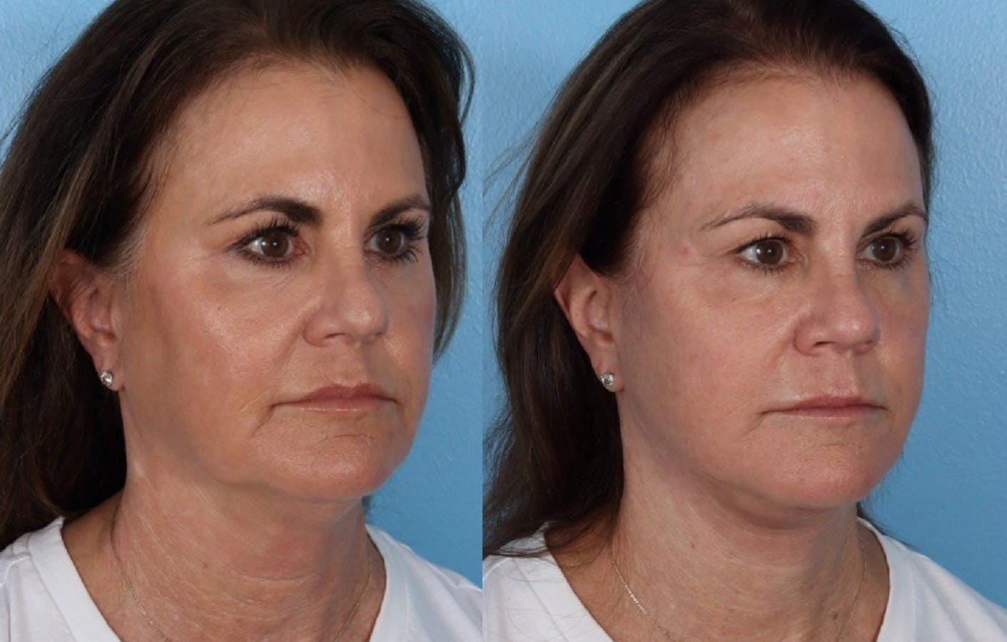 Facelift Before & After Gallery - Patient 796954 - Image 2