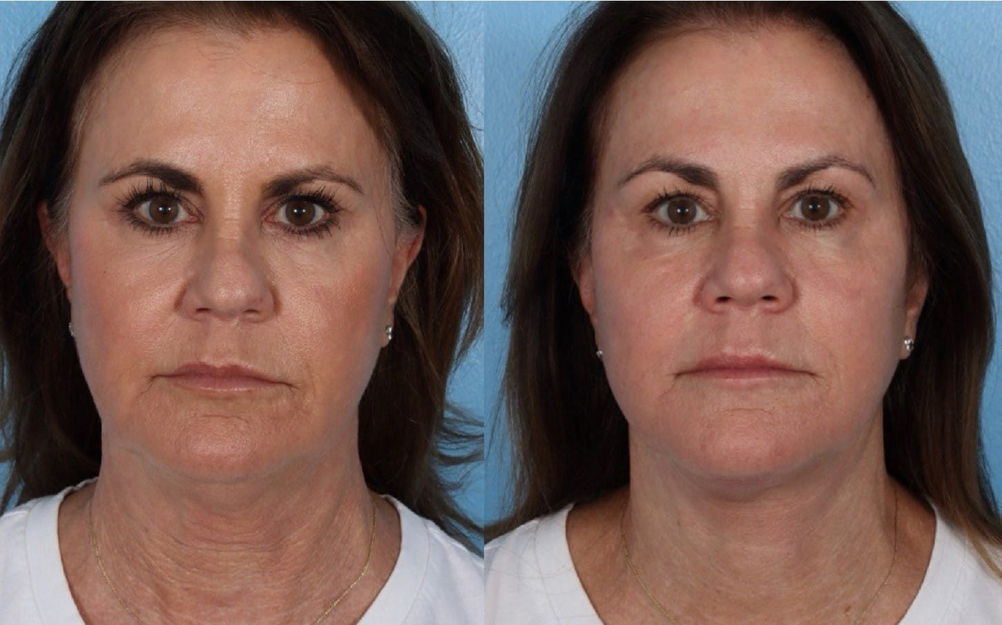 Facelift Before & After Gallery - Patient 796954 - Image 1