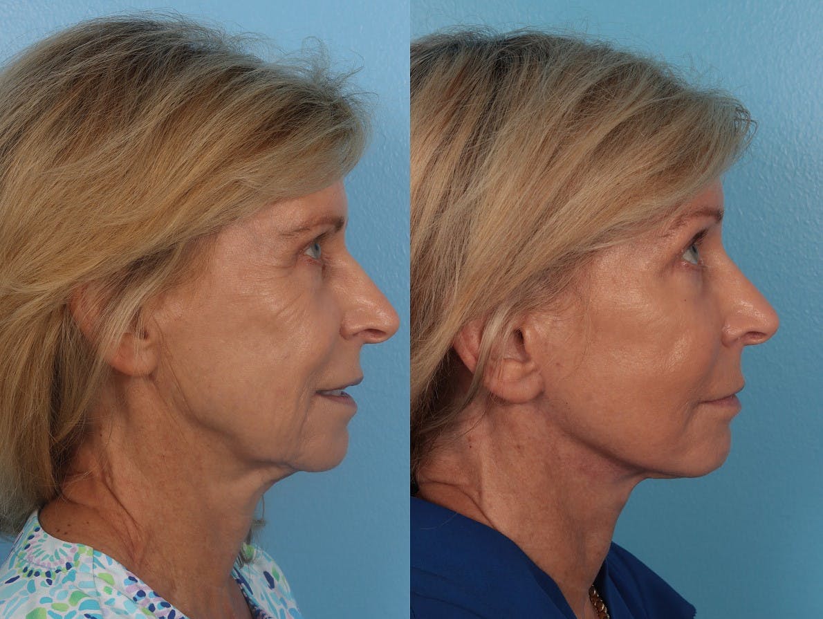 Facelift Before & After Gallery - Patient 135219 - Image 3