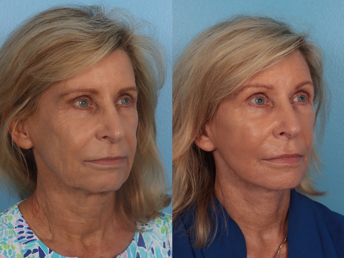 Facelift Before & After Gallery - Patient 135219 - Image 2