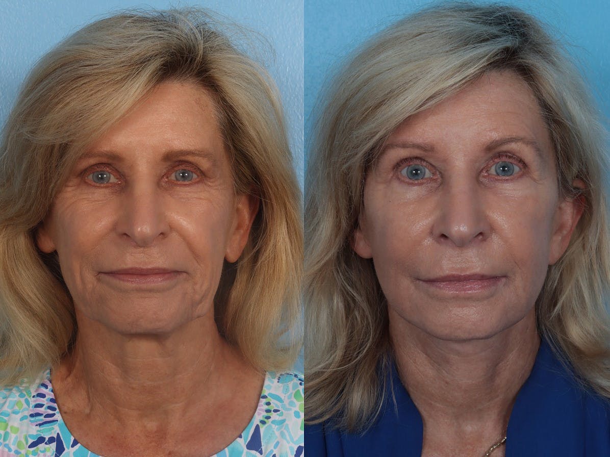 Facelift Before & After Gallery - Patient 135219 - Image 1