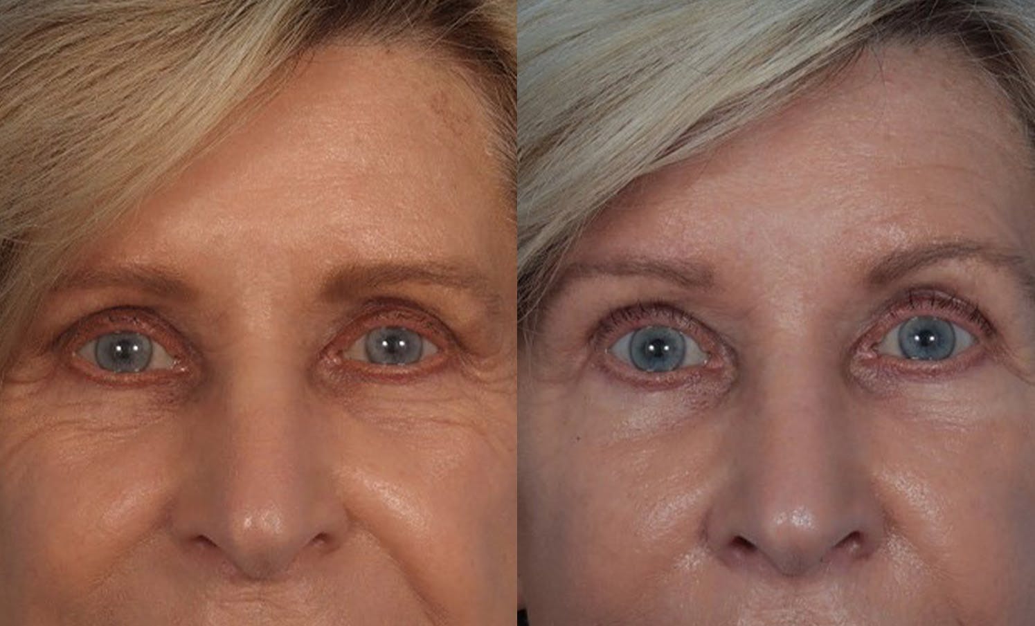Facelift Before & After Gallery - Patient 135219 - Image 4