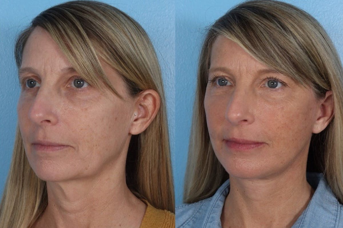 Submental Microliposuction  Before & After Gallery - Patient 273120 - Image 2