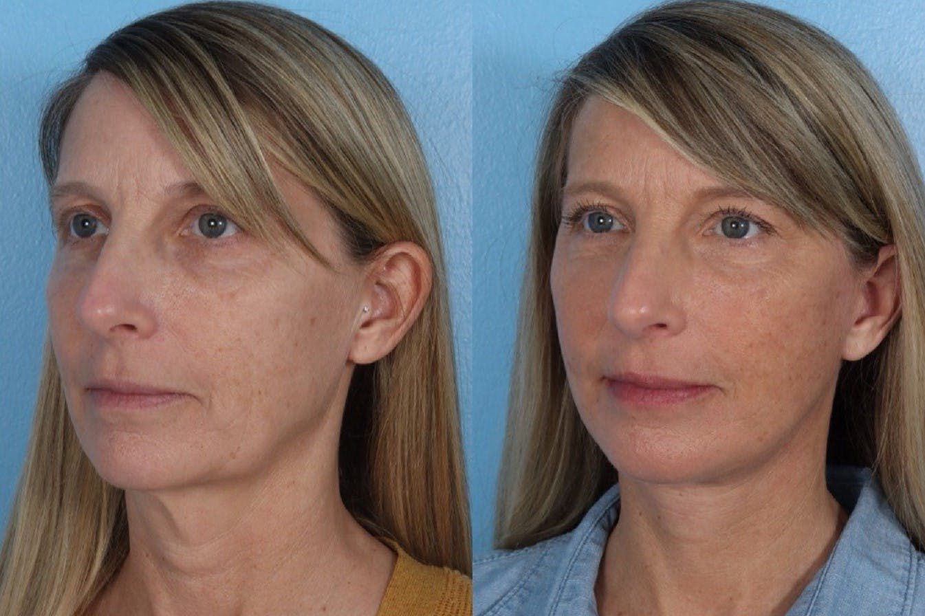 Facelift Before & After Gallery - Patient 264998 - Image 2