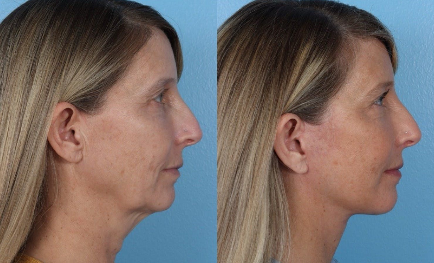 Facelift Before & After Gallery - Patient 264998 - Image 3
