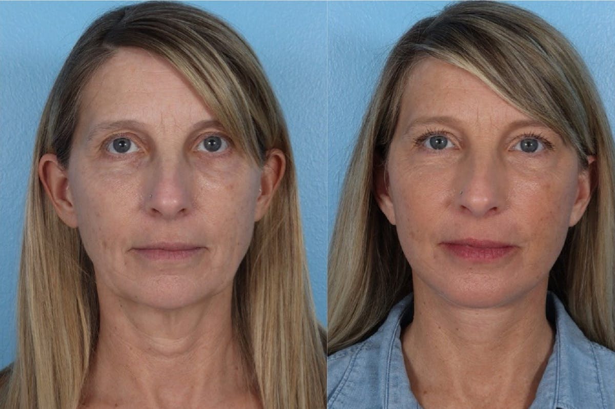 Submental Microliposuction  Before & After Gallery - Patient 273120 - Image 1