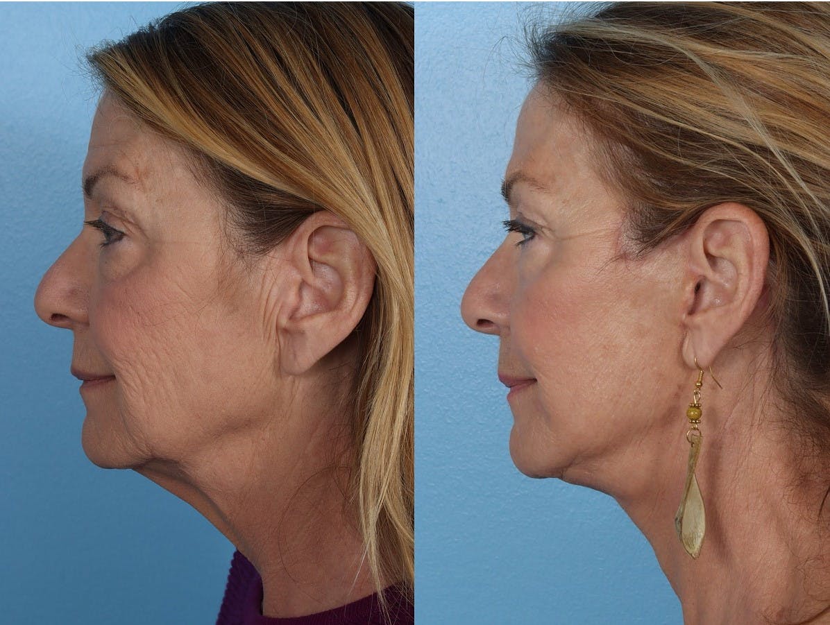 Facelift Before & After Gallery - Patient 310006 - Image 5