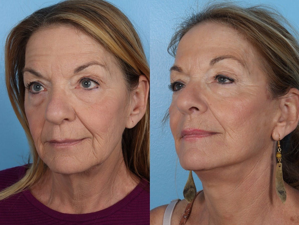 Facelift Before & After Gallery - Patient 310006 - Image 4
