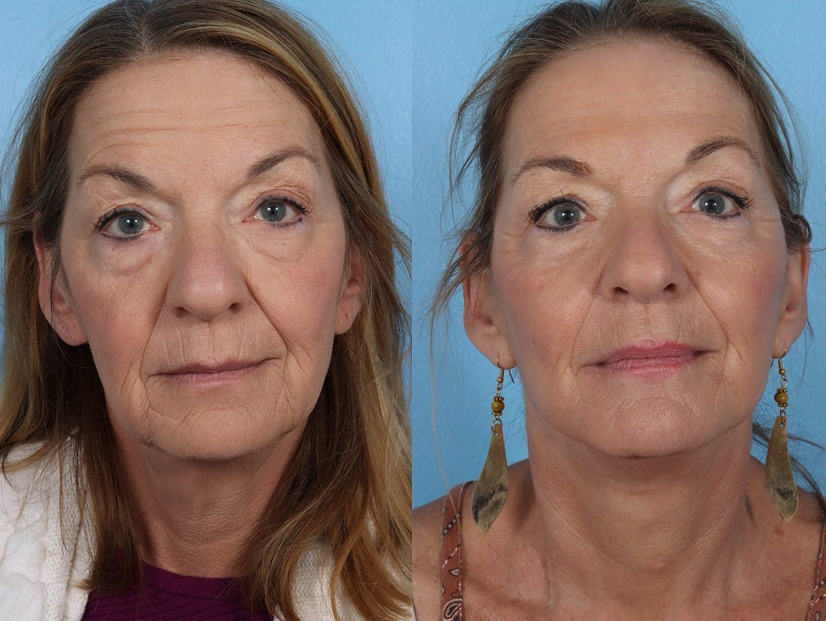 Facelift Before & After Gallery - Patient 310006 - Image 1