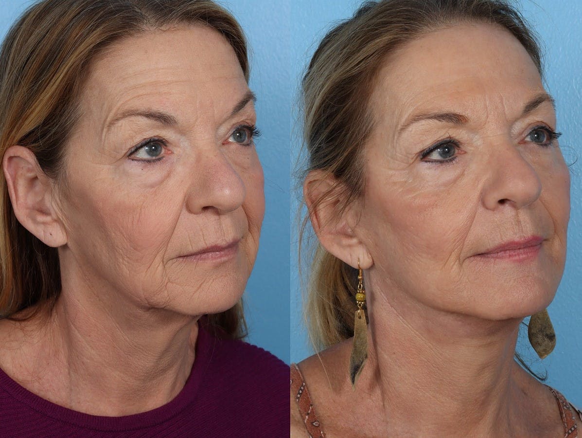 Facelift Before & After Gallery - Patient 310006 - Image 2