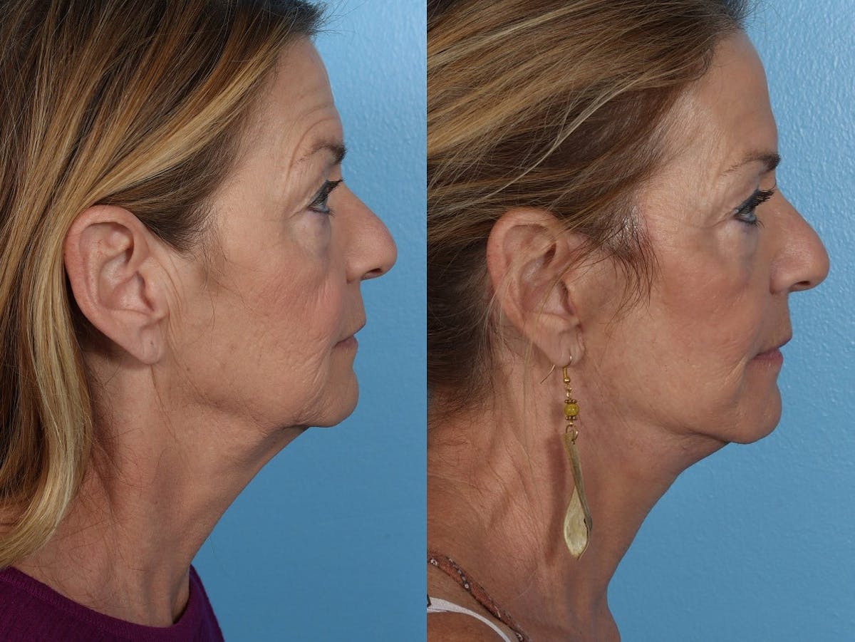 Facelift Before & After Gallery - Patient 310006 - Image 3