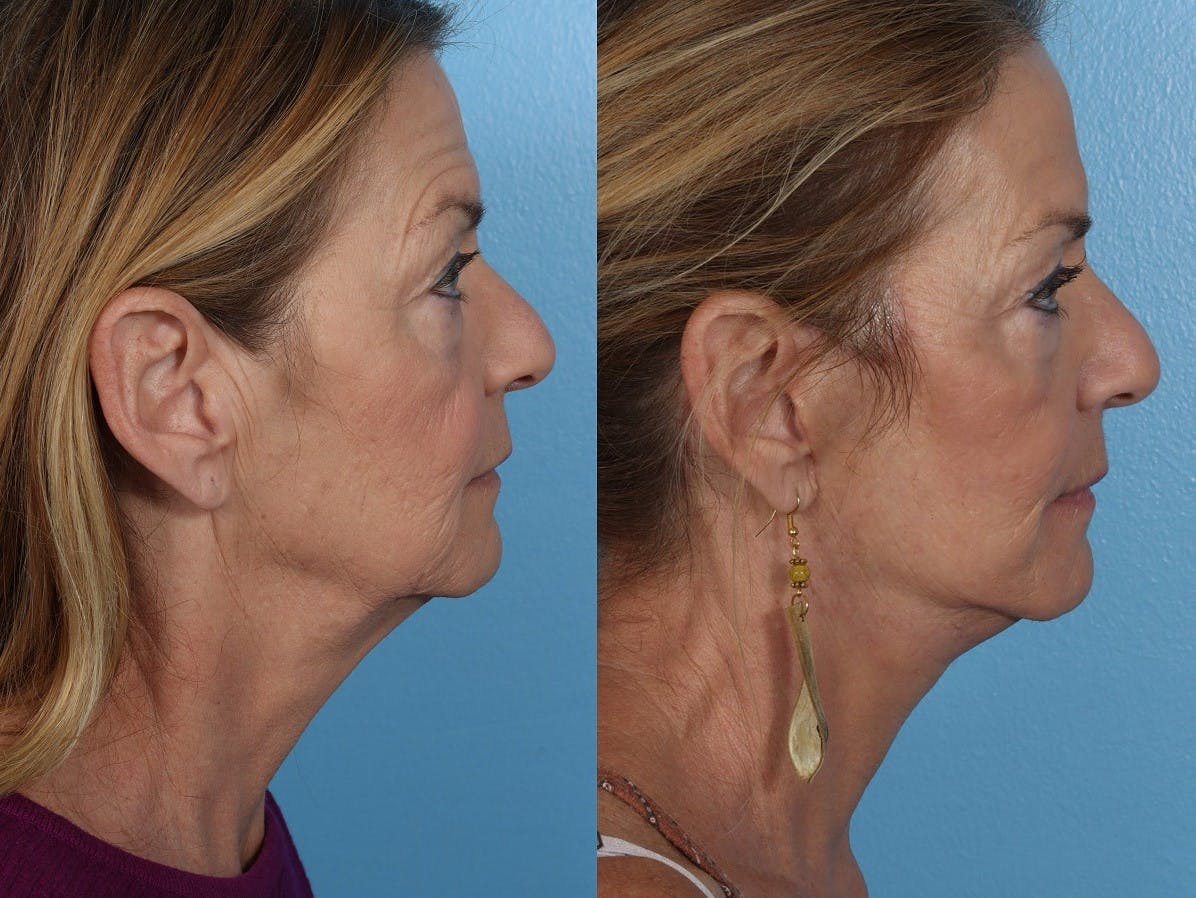Facelift Before & After Gallery - Patient 310006 - Image 3