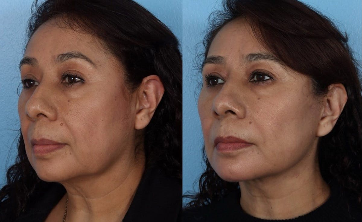 Facelift Before & After Gallery - Patient 984664 - Image 4