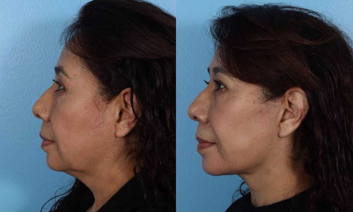 Facelift Before & After Gallery - Patient 984664 - Image 5