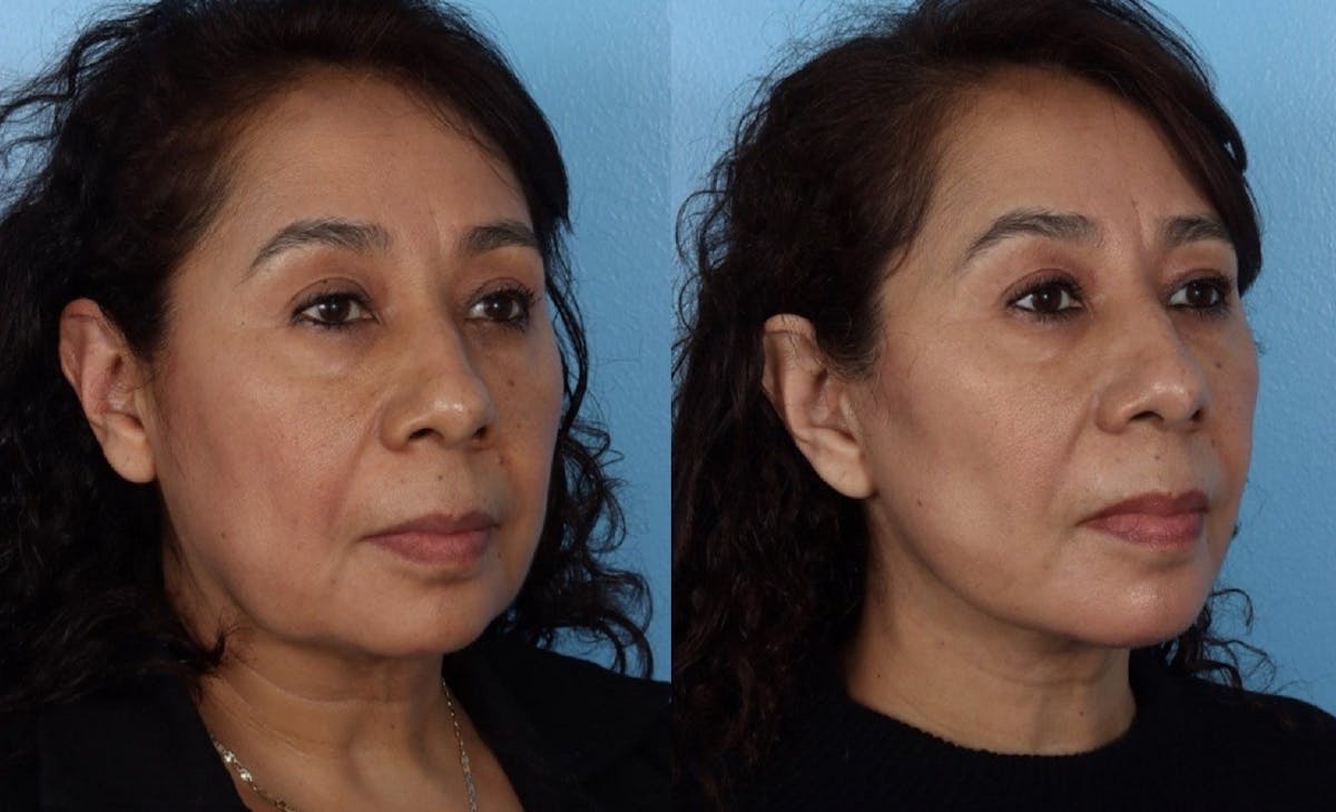 Facelift Before & After Gallery - Patient 984664 - Image 2